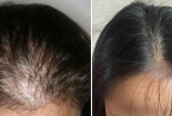 Thuốc chống rụng tóc có thực sự hiệu quả như tin đồn?