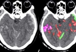 Trí tuệ nhân tạo giúp bác sĩ phát hiện xuất huyết não nhanh hơn