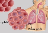 Chủ động phòng chống viêm phổi cấp có nguy cơ xâm nhập vào Việt Nam
