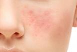 Các loại thuốc 'khắc tinh' của bệnh trứng cá đỏ nên tránh lạm dụng