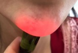 Tiêm filler kém chất lượng: Cảnh báo nguy hiểm từ bác sĩ thẩm mỹ 