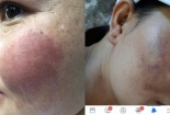 Da mặt biến dạng, đen xì do dùng mỹ phẩm mua qua mạng