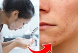 Dùng khăn giấy tẩy trang, sản phẩm dưỡng tóc nhiều cũng có thể gây mụn