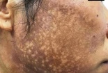 Da mặt chỗ trắng chỗ đen, mạch máu nổi rõ vì bôi kem trộn làm trắng