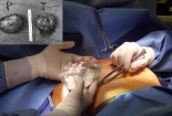 Cảnh báo vỡ túi độn ngực ở những người 'nâng cấp' vòng 1