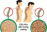 Cảnh báo: Người dùng thuốc corticosteroid trị hen suyễn có nguy cơ bị loãng xương