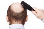 Sử dụng thuốc trị hói đầu có thể làm tăng nguy cơ trầm cảm ở nam giới 