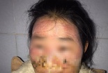 Bị lở loét hết mặt do sử dụng kem trộn không rõ guồn gốc 