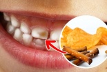Những thực phẩm gây hại cho sức khỏe răng miệng người dùng cần tránh 
