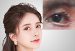 Những biến chứng nguy hiểm khi phẫu thuật mở góc mắt