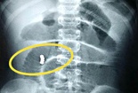 Gia tăng số trẻ nuốt phải nam châm gây biến chứng nguy hiểm, cha mẹ nên cảnh giác