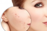 Mỹ phẩm trị mụn chứa chất Benzoyl Peroxide liều lượng cao có thể gây nguy hiểm sức khỏe