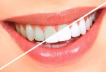 Những nguy cơ thường gặp từ việc tẩy trắng răng