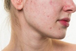Bôi kem đánh răng lên mặt trị mụn gây nhiều tác hại, cần tuyệt đối tránh