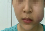 Mặt cô gái sưng phồng, nghi tiêm filler trôi nổi không đảm bảo chất lượng