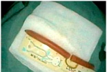 Cây nến nằm trong trực tràng bé trai 5 tháng tuổi do bất cẩn của người lớn