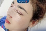 Nâng mũi cấu trúc- giải pháp tối ưu cho những người nâng mũi bị hỏng