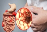 Căng thẳng có phải là nguyên nhân gây ra bệnh Crohn?