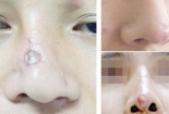 Cô gái 29 tuổi bị biến chứng sau nâng mũi làm đẹp 'chui' ở chung cư