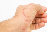 Cảnh báo tình trạng độc tố nhiễm khuẩn uốn ván