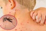 Tăng cường triển khai điều trị cho bệnh nhân sốt xuất huyết