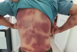 Toàn thân lở loét, nhiễm độc do tự mua thuốc bôi điều trị dị ứng 