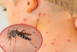 Sử dụng kit test sốt xuất huyết tại nhà tiềm ẩn nhiều nguy cơ, thậm chí tử vong
