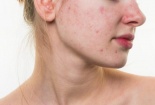 Người tiêu dùng cần lưu ý khi sử dụng kem chống nắng nếu da đang bị mụn