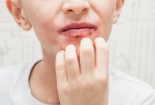 Trẻ nhỏ có thể bị dị ứng kem đánh răng gây bệnh nghiêm trọng