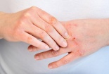 Người mắc bệnh viêm da cơ địa cần tránh lựa chọn các thực phẩm này