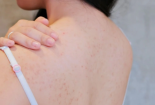 Dùng thuốc gây tê khi lăn kim chữa mụn có thể gây khó thở, rối loạn tri thức