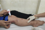 Tự ý điều trị bệnh chốc ở trẻ nhỏ tại nhà tiềm ẩn nhiều nguy hại sức khỏe