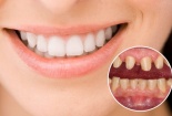 Bác sĩ nha khoa cảnh báo tác hại không mong muốn nếu bọc răng sứ giá rẻ, kém chất lượng 