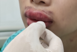 Sau tiêm filler 'Hàn Quốc' giá rẻ khiến môi sưng phồng, nhiễm trùng nặng