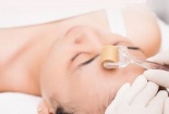 Bác sĩ cảnh báo nhiều hậu quả nếu lăn kim chữa mụn trên mặt sai cách