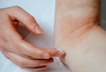 Tự ý bôi thuốc điều trị chàm da cơ địa người đàn ông bị nhiễm trùng nặng