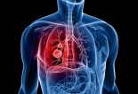 Mỹ phê duyệt thuốc mới điều trị ung thư phổi giai đoạn cuối
