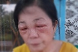 Nhuộm tóc đón Tết người phụ nữ bị phù mặt, tróc lở da