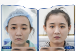 Sửa cắt mí mắt hỏng, nhược cơ tại Thẩm mỹ viện Adona