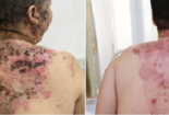 Chữa bệnh bằng tắm lá cây không rõ nguồn gốc gây bội nhiễm nguy hiểm tính mạng