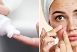 Nữ sinh nếm trái đắng vì chữa mụn bằng kem đánh răng