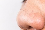 Tác dụng phụ của những loại thuốc điều trị mụn trứng cá cần lưu ý khi dùng