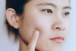 Dùng sản phẩm treatment đặc trị theo tư vấn trên mạng, nhiều người nhận 'trái đắng'
