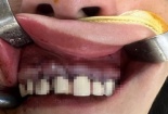 Bọc răng sứ có thể gặp biến chứng nang xương hàm nguy hiểm