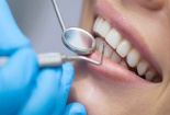 Tác hại khi dán răng sứ veneer kém chất lượng, những lưu ý để đảm bảo an toàn
