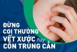 Sốc độc tố do nhiễm trùng: Bệnh có nguy cơ tử vong cao song ít ai ngờ