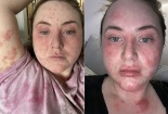 Dị ứng, viêm nhiễm toàn thân do dán răng sứ veneer chứa thành phần nhựa thông