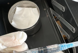 Cảnh báo: Hoại tử mí mắt do tiêm filler bằng gel oxy già tẩy trắng răng