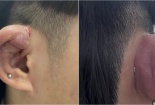 Bấm khuyên ở cơ sở không uy tín nhiều bạn trẻ bị áp xe vành tai
