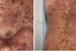 Nguy cơ dị ứng thuốc nặng thể TEN sau dùng thuốc nam điều trị sỏi thận